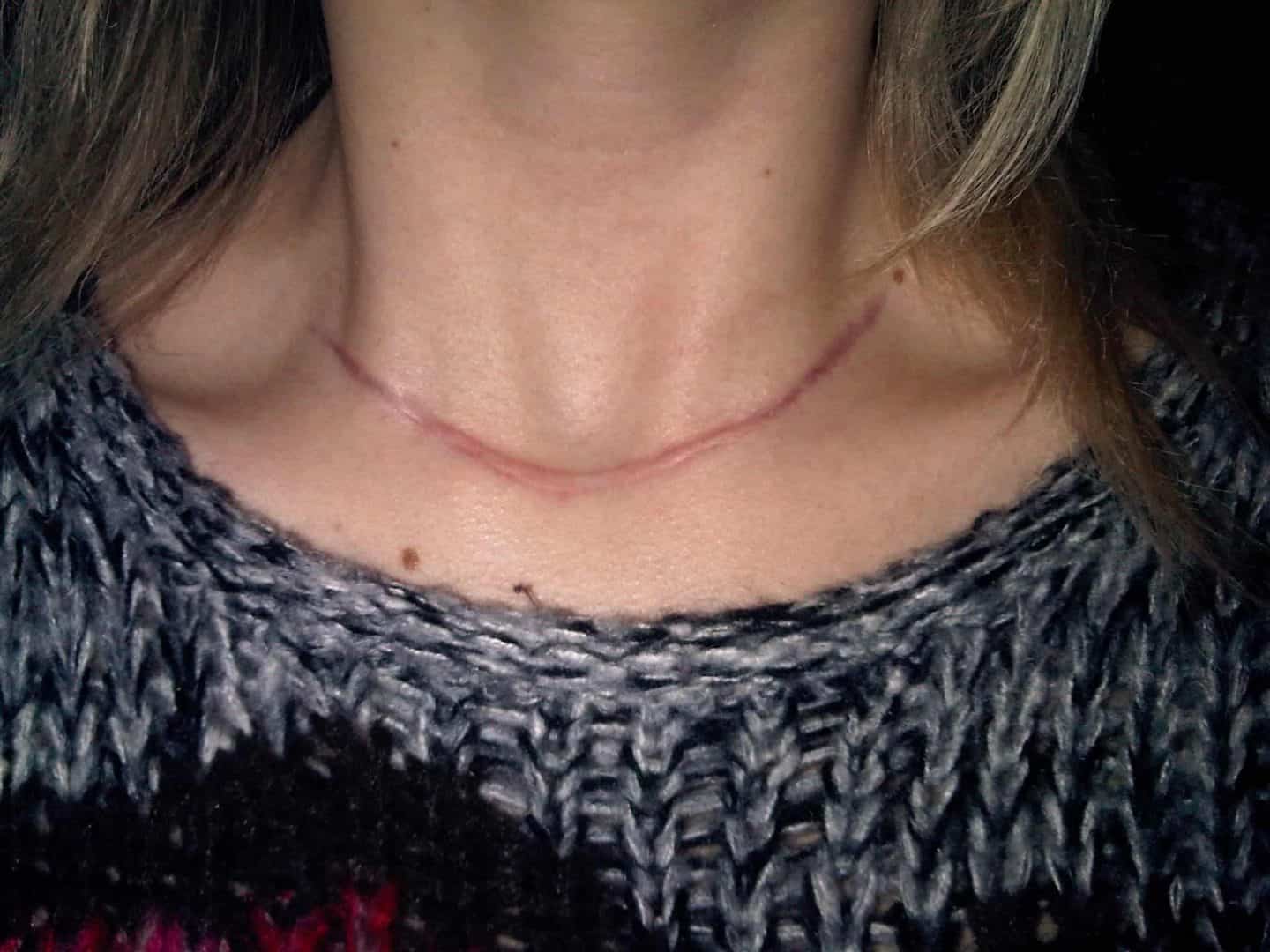 Three months post-thyroid!